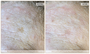 Age Spots Patient 03 - 4