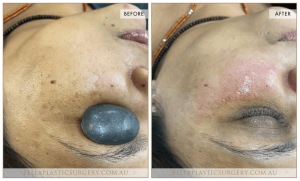 Age Spots Patient 06 - 7