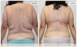 Bra Lipectomy Patient 16 - 17
