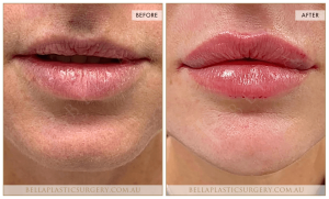‘Kiss Me’ Lip Augmentation 10 - 11