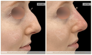 Non-Surgical Rhinoplasty 09 - 10