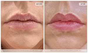 ‘Kiss Me’ Lip Augmentation 11 - 12