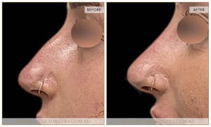 Non-Surgical Rhinoplasty 10 - 11