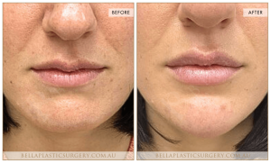 ‘Kiss Me’ Lip Augmentation 12 - 13