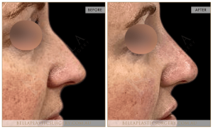 Non-Surgical Rhinoplasty 11 - 3