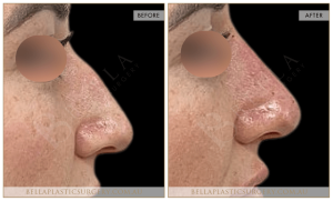 Non-Surgical Rhinoplasty 12 - 12