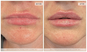 ‘Kiss Me’ Lip Augmentation 14 - 15