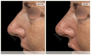 Non-Surgical Rhinoplasty 13 - 13