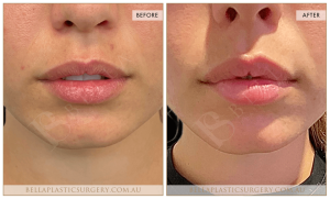 ‘Kiss Me’ Lip Augmentation 15 - 16