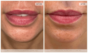 ‘Kiss Me’ Lip Augmentation 16 - 17