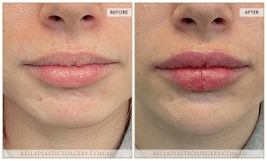 ‘Kiss Me’ Lip Augmentation 17 - 18
