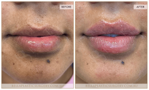 ‘Kiss Me’ Lip Augmentation 18 - 19