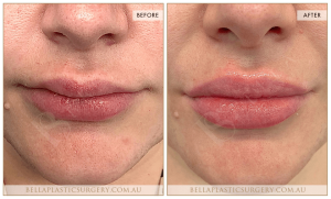 ‘Kiss Me’ Lip Augmentation 19 - 20