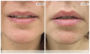 ‘Kiss Me’ Lip Augmentation 20 - 21