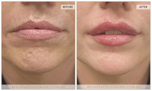 ‘Kiss Me’ Lip Augmentation 21 - 22