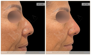 Non-Surgical Rhinoplasty 14 - 14