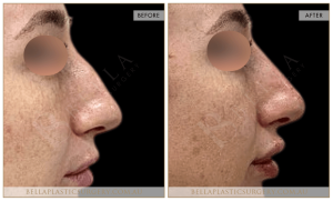 Non-Surgical Rhinoplasty 15 - 15