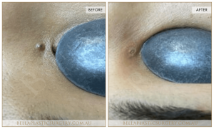 Laser Mole Removal 03 4 Laser Mole Removal 03 - 4
