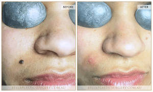 Laser Mole Removal 04 5 Laser Mole Removal 04 - 5