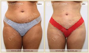 Buttock Lift Patient 02 - 24