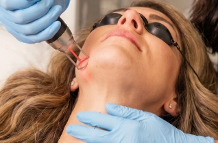 Neck and Décolletage – Bella Plastic Surgery Sydney