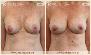 Revision Breast Patient 22 - 15