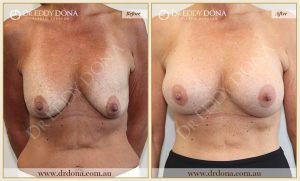 Revision Breast Patient 15 - 7