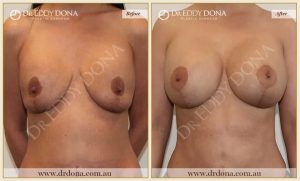 Revision Breast Patient 18 - 10