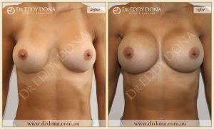 Revision Breast Patient 14 - 6