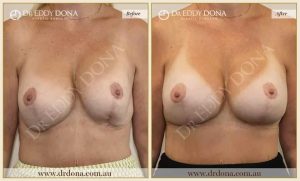 Revision Breast Patient 19 - 11