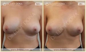 Revision Breast Patient 20 - 13
