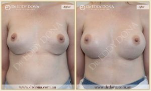Revision Breast Patient 13 - 5
