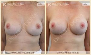 Revision Breast Patient 16 - 8