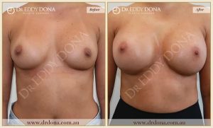 Revision Breast Patient 17 - 9