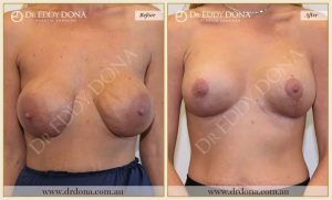 Revision Breast Patient 7 - 20