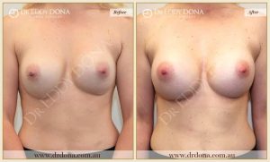 Revision Breast Patient 8 - 21