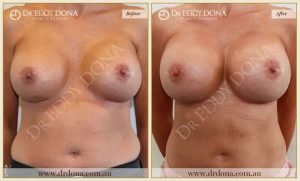 Revision Breast Patient 9 - 22