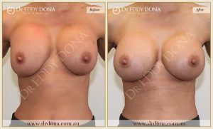 Revision Breast Patient 5 - 18