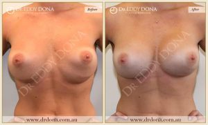 Revision Breast Patient 2 - 12