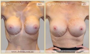 Revision Breast Patient 6 - 19