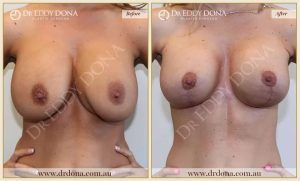Revision Breast Patient 1 - 1