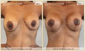 Revision Breast Patient 4 - 17