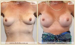 Revision Breast Patient 3 - 16