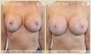 Revision Breast Patient 11 - 3