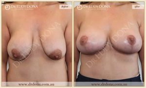 Revision Breast Patient 12 - 4