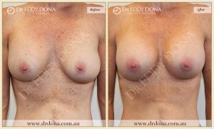 Revision Breast Patient 10 - 2