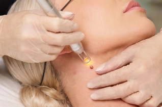 Laser Skin Tag Removal – Bella Plastic Surgery Sydney