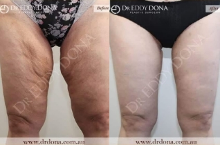 Thigh Lift (Lipectomy) 1 Thigh Lift (Lipectomy) - 1