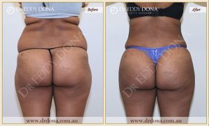 Buttock Lift Patient 01 - 23