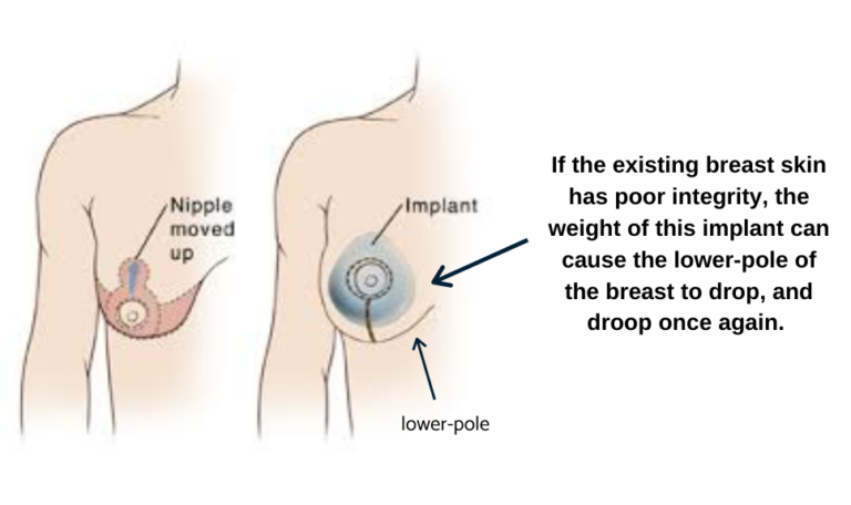 Breast implants after breast reduction, breast implants after breast lift, breast lift with implants